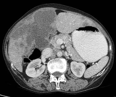 Figure 3: large polypoidal fungating gallbladder mass with gross invasion of liver parenchyma. Hepato-duodenal ligament invaded. Left lobe shows discrete secondaries.